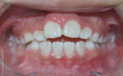 foto frontal de dientes previa ortodoncia