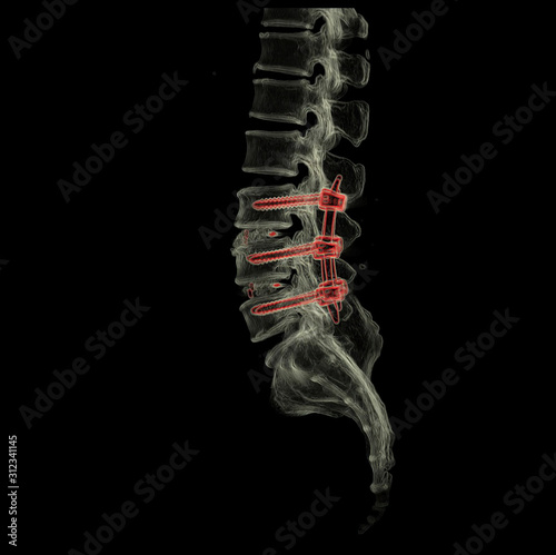 3D computed tomography (CT) of L-S spine in lateral view with transparent bone technic.