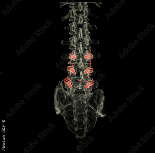 3D computed tomography (CT) of L-S spine in AP view with transparent bone technic.