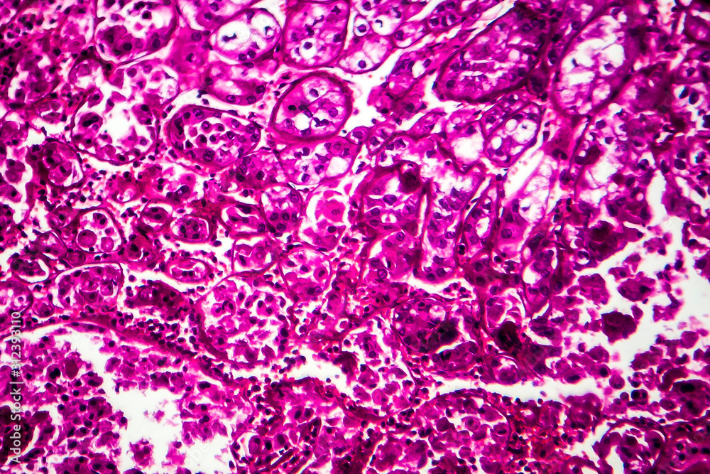 Kidney cancer, light micrograph, photo under microscope Kidney cancer, light micrograph, photo under microscope