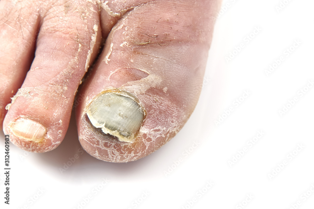 Toenail fungus isolated on white. Sore toenail, nail fungus close up photo Toenail fungus isolated on white. Sore toenail, nail fungus close up photo
