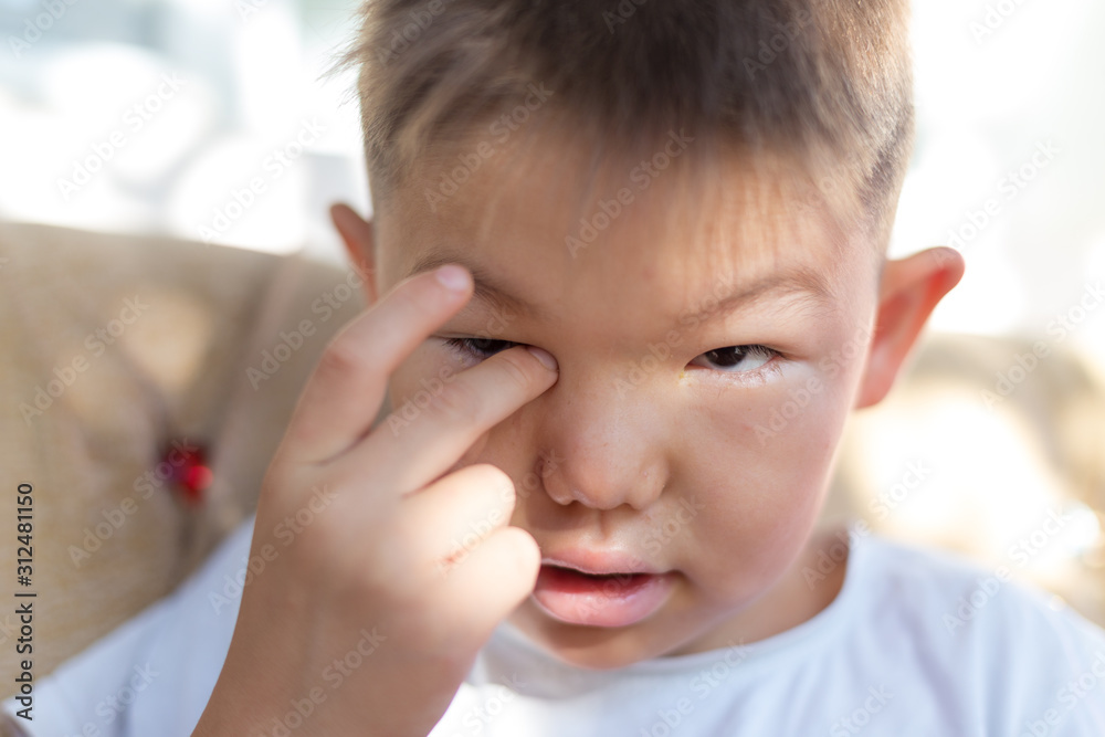 Good morning. Cute boy woke up with a swollen face Good morning. Cute boy woke up with a swollen face