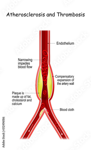 Atherosclerosis and Thrombosis