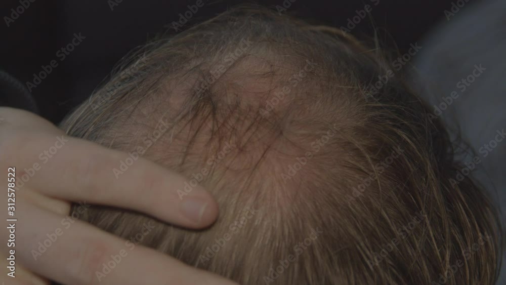 Close up of hand rubbing bald spot on man's head Close up of hand rubbing bald spot on man's head