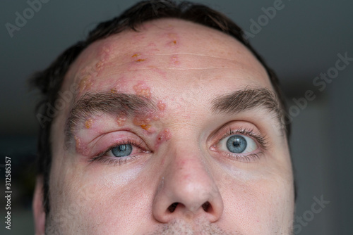 Man with Herpes Zoster (shingles) on the face, close up. Inflamed eyelid and red eye of a man suffering from herpes on the face. Purulent blisters on the face during Shingles photo