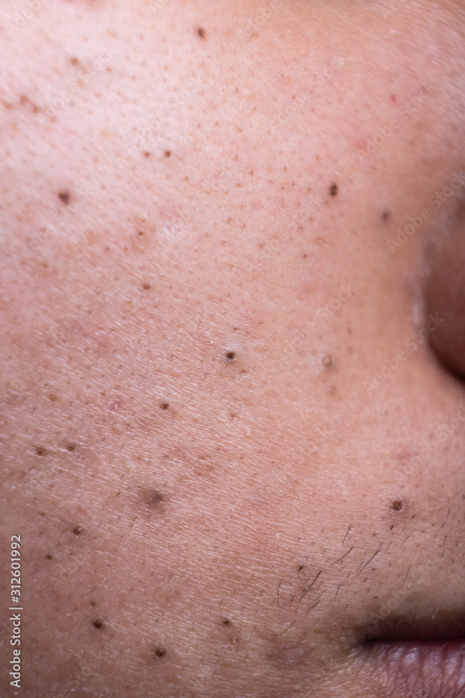 Ugly pimples blackheads on cheek face of teenager Stock Photo | Adobe Stock