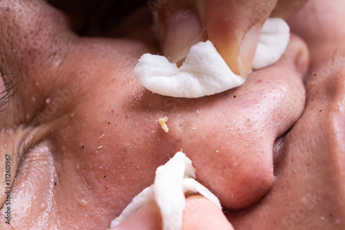 Finger squeezing popping whiteheads pus pimple form face of teenager photo