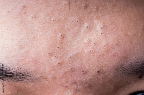 Ugly pimples blackheads on forehead of teenager