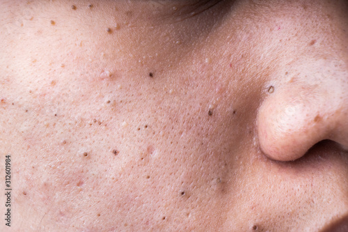 Ugly pimples blackheads on cheek face of teenager photo