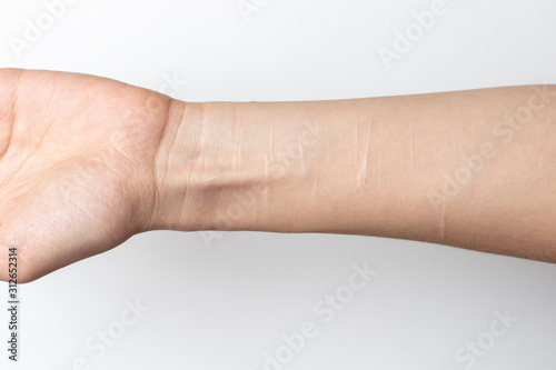 female hand close-up with scars from cuts by a blade.