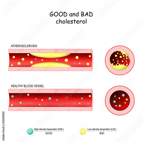 Fotografie, Obraz good (HDL) and bad (LDL) cholesterol