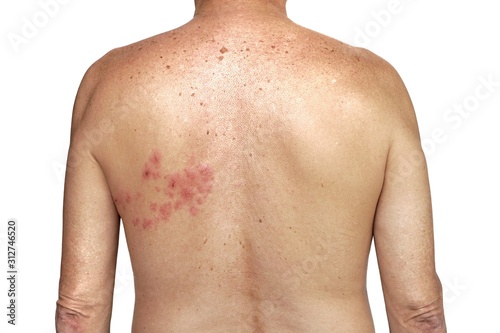 Herpes zoster on the right side of torso on the white background photo