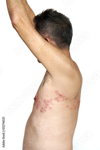 Herpes zoster on the left side of torso on the white background