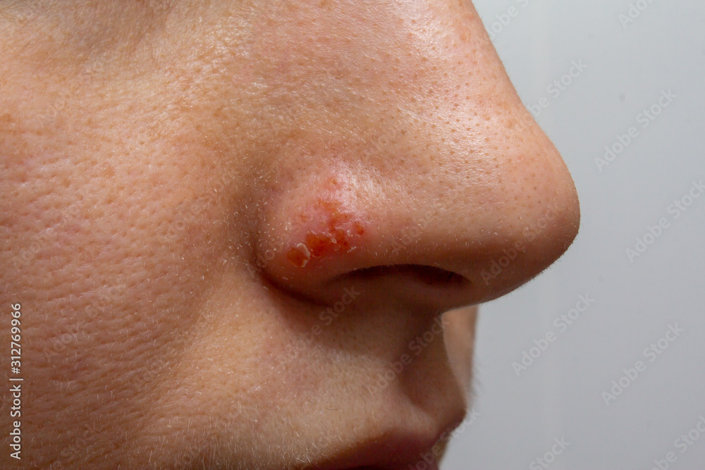 Herpes on the nose - Pretty young caucasian woman with herpes her on nose, close-up. Human Virus Herpes on the nose - Pretty young caucasian woman with herpes her on nose, close-up. Human Virus