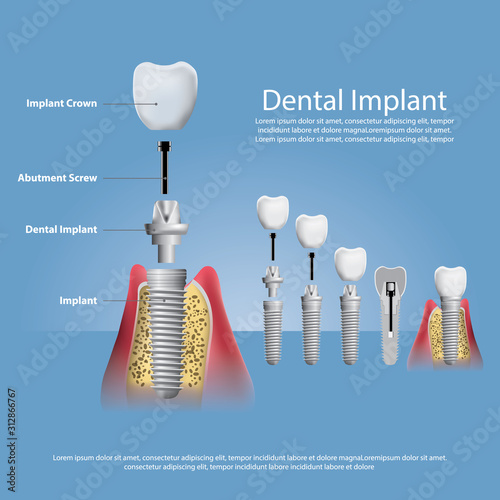 Human teeth and Dental implant Vector Illustration