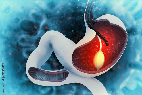 stomach Endoscopy.Gastric Balloon Inside a Stomach