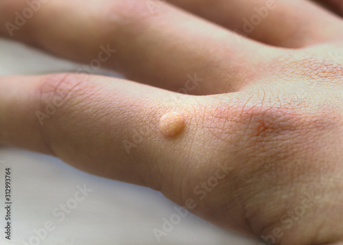 Common wart ( Verruca vulgaris ) a flat wart commonly found on the hand  of children and  adults. They are caused by a type of human papillomavirus ( HPV ) photo