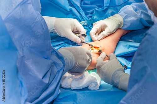 Group of surgeons performing an elbow surgery