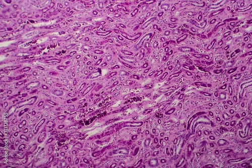 Diffuse proliferative glomerulonephritis