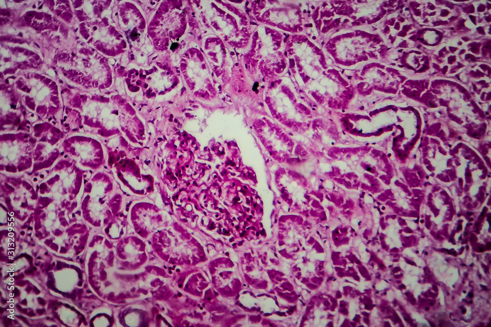 Obraz premium Diffuse sclerosing glomerulonephritis