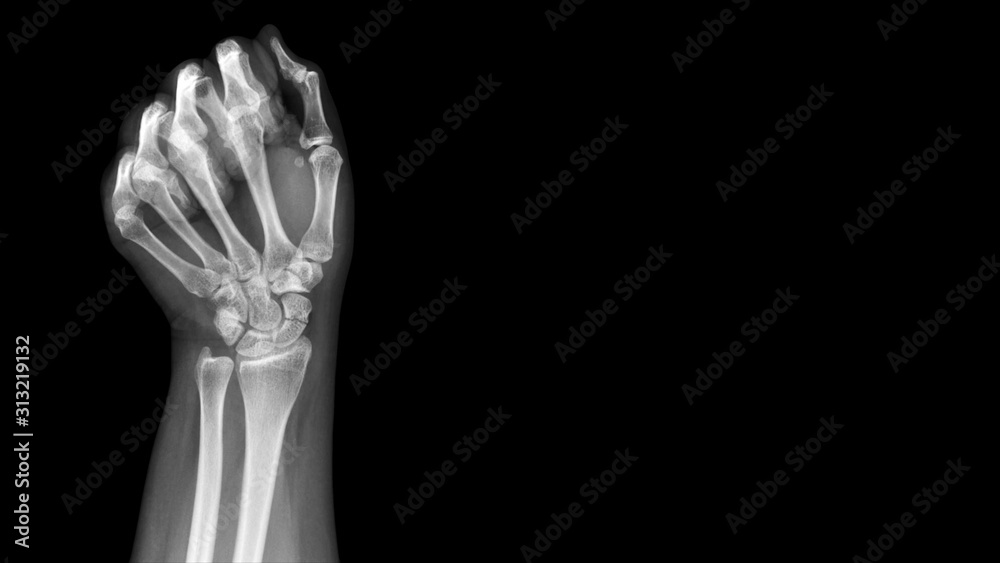 Film X ray wrist radiograph show show carpal bone broken (scaphoid fracture). The patient has wrist pain, swelling and deformity. Medical imaging and orthopedic technology concept Film X ray wrist radiograph show show carpal bone broken (scaphoid fracture). The patient has wrist pain, swelling and deformity. Medical imaging and orthopedic technology concept