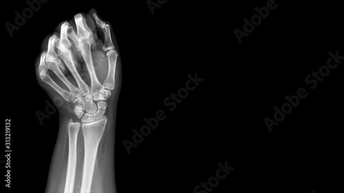 Film X ray wrist radiograph show show carpal bone broken (scaphoid fracture). The patient has wrist pain, swelling and deformity. Medical imaging and orthopedic technology concept photo