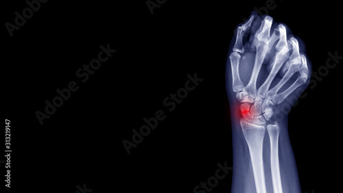 Fotografia Film X-ray wrist radiograph show carpal bone broken (scaphoid fracture) from falling