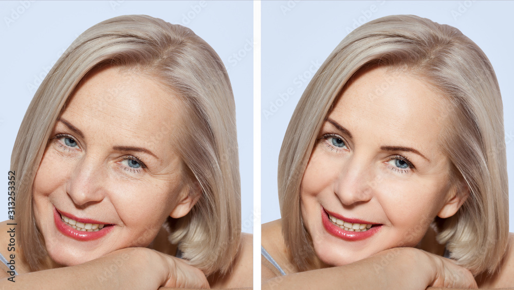 Middle age close up woman happy face before after cosmetic procedures. Skin care for wrinkled face. Before-after anti-aging facelift treatment. Facial skincare and contouring. Middle age close up woman happy face before after cosmetic procedures. Skin care for wrinkled face. Before-after anti-aging facelift treatment. Facial skincare and contouring.