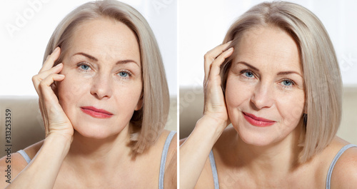 Middle age close up woman happy face before after cosmetic procedures. Skin care for wrinkled face. Before-after anti-aging facelift treatment. Facial skincare and contouring.