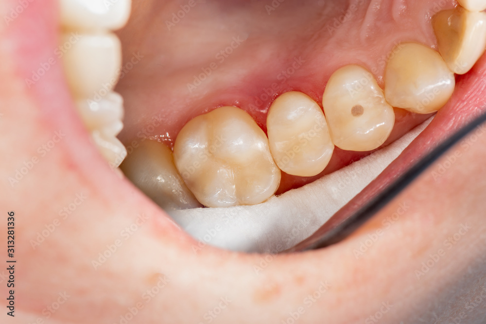 Obraz premium two chewing side teeth of the upper jaw after treatment of caries. Restoration of the chewing surface with a photopolymer filling material using the Rubber Dam system