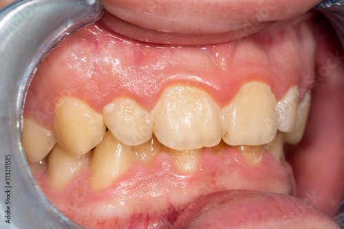 Plaque of the patient, stone. Dentistry treatment of dental plaque, professional oral hygiene. The concept of harm to smoking and cleaning teeth