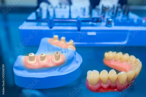 Orthodontics. Nylon dentures. The work of a dental technician. Dental implantation. Creation of plastic prostheses. Concept - orthodontic office. Modern dentures for teeth. Dental treatment. Jaws