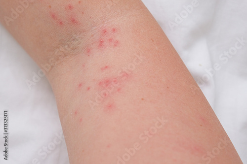Skin rash on female arm, itchy pimples as a result of an allergic reaction, response, concept of allergy and dermatology