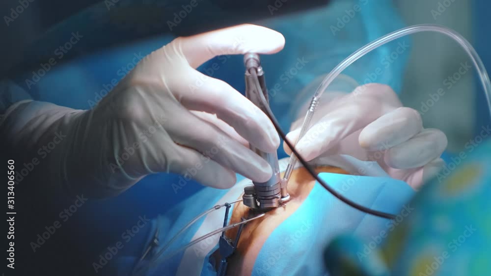 Sharp Vision Laser vision correction. A patient and team of surgeons in the ...