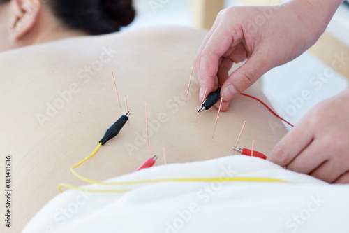 hand of doctor performing acupuncture therapy . Asian female undergoing acupuncture treatment with a line of fine needles inserted into the her body skin in clinic hospital