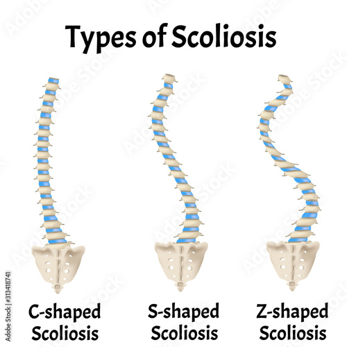 Types of Scoliosis. C, S, Z shaped scoliosis. Dextroscoliosis. Levoscoliosis. Spinal curvature, kyphosis, lordosis, arthrosis. Infographics. Vector illustration on isolated background.