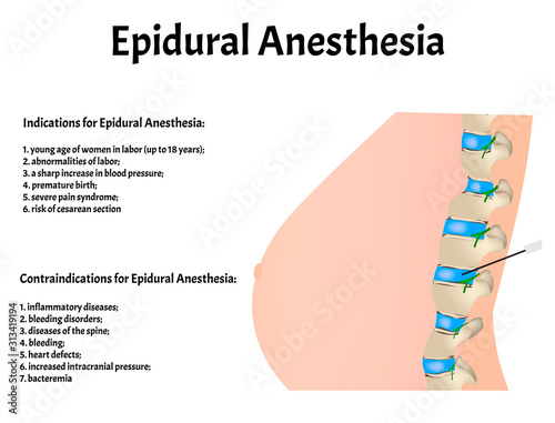 Epidural anesthesia during childbirth. Epidural anesthesia of pregnant women. Indications and contraindications. Vector illustration