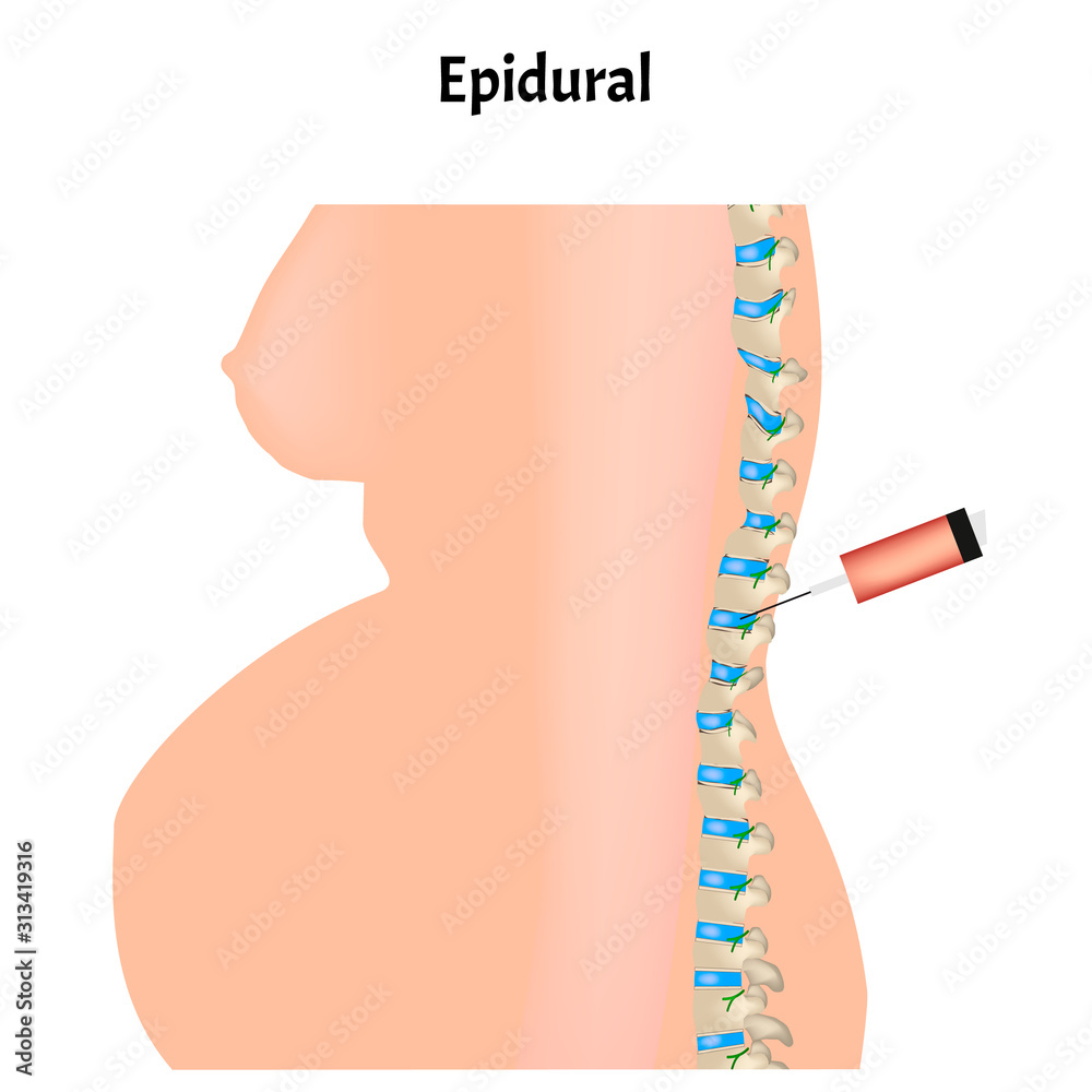 Epidural anesthesia during childbirth. Epidural anesthesia of pregnant