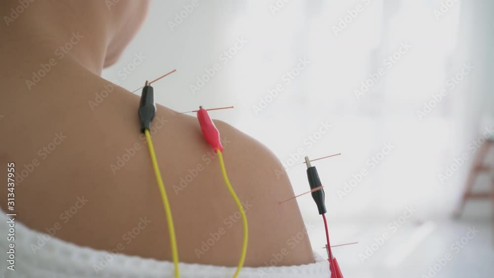 Close up asian woman Traditional Chinese and Electro acupuncture on body of patient at clinic Alternative medicine concept Close up asian woman Traditional Chinese and Electro acupuncture on body of patient at clinic Alternative medicine concept