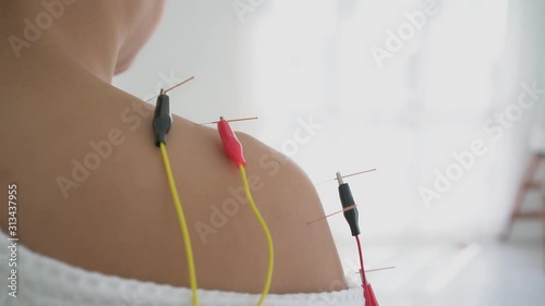 Close up asian woman Traditional Chinese and Electro acupuncture on body of patient at clinic Alternative medicine concept