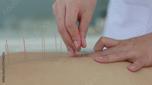 hand of doctor performing acupuncture therapy . Asian female undergoing acupuncture treatment with a line of fine needles inserted into the her body skin in clinic hospital photo