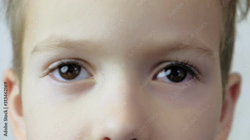 4K Close up. Little boy shows the eyes with conjunctivitis. The viral on eye. 4K Close up. Little boy shows the eyes with conjunctivitis. The viral on eye.