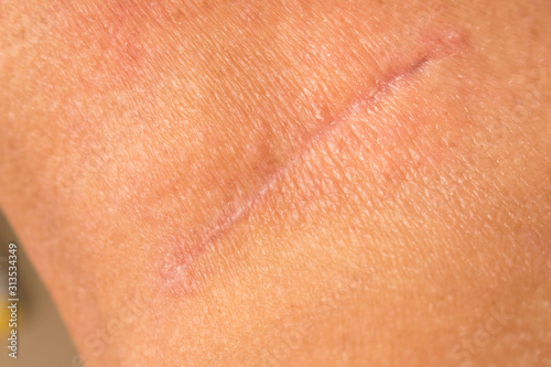 Suture after surgery on the human neck. The scar after the surgery. Close up.