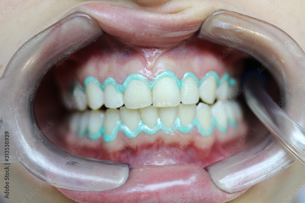 Obraz premium Teeth Whitening 