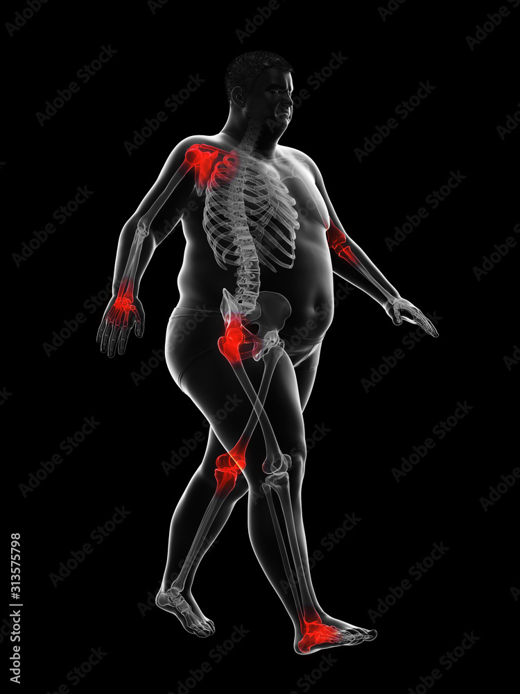 3d rendered medically accurate illustration of an obese runners painful joints 3d rendered medically accurate illustration of an obese runners painful joints