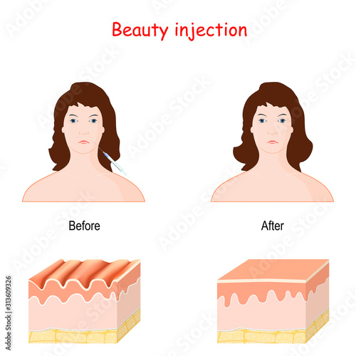 beauty injection. dermal filler.