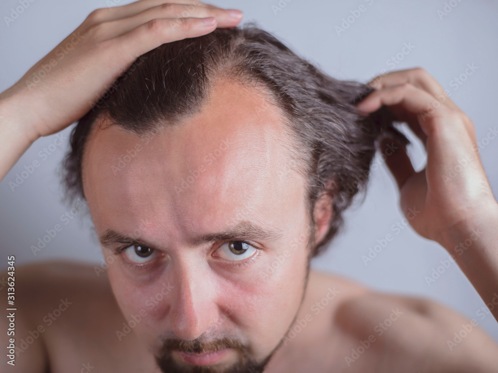 Obraz premium Portrait of a young guy with magnificent hair that falls early on his forehead. The problem of premature aging. Combing hair and indignantly looking in the mirror