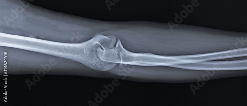 Fototapeta Naklejka Na Ścianę i Meble -  x-ray of the normal elbow joint. traumatology and orthopedics, medical diagnostics, rheumatology