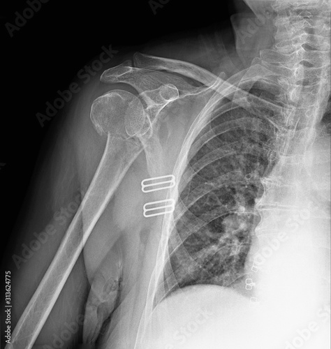 radiography of the shoulder joint in direct projection with a fracture of the head of the humerus, Traumatology and orthopedics, traumatology, sports injury