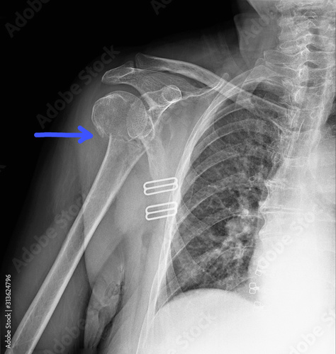 radiography of the shoulder joint in direct projection with a fracture of the head of the humerus, Traumatology and orthopedics, traumatology, sports injury